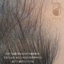 브라운도트 수원정자점 | [M자탈모] 엠자탈모 분당두피문신 가격부터 후기까지! (SMP vs 안개기법 총정리)