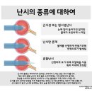 부산아이센터안과의원 네이버블로그