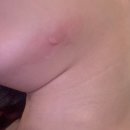스타S피부과의원 | 서초 방배 연세스타피부과의원 켈로이드 흉터치료 5회차, 내돈내산 솔직후기