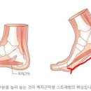 족저근막염 증상 원인 족저근막염 치료방법 발바닥 통증 이미지