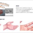 손목 결절종 손바닥 발등 치료 수술 (손목 물혹 손가락 복숭아뼈) 이미지
