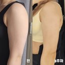 인천 팔뚝 무한람스 3주차 후기 부유방빼기로 옷태완성