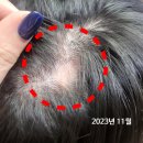 당신의약국 | 탈모샴푸 사용 전 읽어보세요(여자 탈모 해결 과정)