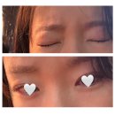 둔산요양병원 | 대전 스마일라식 삼성스마일안과 비용, 할인 방법 내돈내산 후기