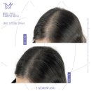 탈모왕