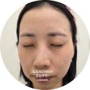 [수지구청피부과]피부미용시술 수지구청_비립종 한관종 등_메이퓨어의원 수지점