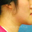 양재역치과 반대교합 교정사례 (30대 남성)