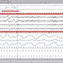 수면단계(Sleep Stages)의 이해, 렘수면, 비렘수면 이미지