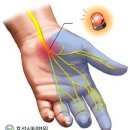 MXM 재활운동 이미지