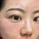 역삼피부과 콜라스터포텐자후기 스킨부스터 넥소좀 효과