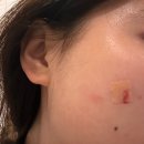 한림피부과의원 | 한남동 피부과 2회차 방문, 찐 쥬베룩 아이 후기