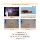 다발성감입된담석증수술후기. 단일공복강경을 통해 수술을 진행할 뿐만 아니라 5,800회의 수술 성공사례를 통해 원장님에 대한 확신이... 이미지