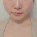삼성역피부과 티원 하이브리드 후기 옆볼패임 개선 시술 전후 변화 부작용, 관리