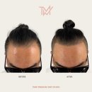 탈모왕수원 이미지