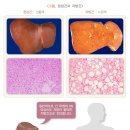 지방간의 진단과 관리 이미지