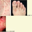 국내에서 수족구병으로 첫 사망자 발생.수족구병 예방법. 이미지