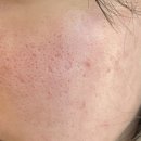 닥터오케이의원 | 명동 피부과 [닥터에버스의원 명동점] 후기 ( ´ิ(ꈊ) ´ิ)