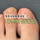 자연네일 | 평촌 내성발톱 자연네일 무좀 안양범계점 등산후 빠져버린 문제성발 해결후기