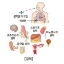 결핵성 복막염(Tuberculous peritonitis) 이미지