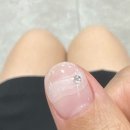 누스네일