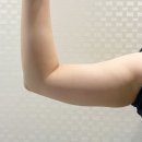 비앤에스 | 삼성비앤에스의원 슬림핏주사 팔뚝주사 후기(+한달)