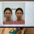 금손한의원 | 수원 리샘한의원 안면비대칭교정 팔자매선 내돈내산 찐후기