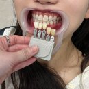 원데이 치아미백 유명한 레브치과 내돈내산으로 받아본 신사역 치과 솔직후기