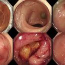 장천공[Bowel perforation] 이미지