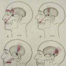 [MPS] 총론 8 - 측두근 Temporalis 이미지