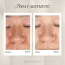 화중로104번길 | 화정역피부관리 오늘에스테틱 모공관리로 다시 태어난 꿀피부 후기