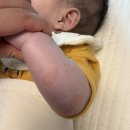 동진환경 | [육아] 아기 피부에 동그란 붉은 반점? | 우리아기 동진 습진 경험 후기