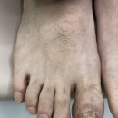 과천 내성 발톱무좀 병원에서 깔끔 관리 후기