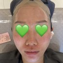 육단10세천 | PDRN 포텐자 주사 시술 내돈내산 후기 (긴글주의, 불만 많음 주의)