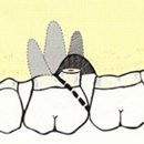 치근절제술[Root resection] 이미지