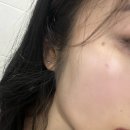 씨제이올리브영(주)강남논현점 | 신논현역피부과 ECM스킨부스터 셀르디엠 효과, 가격, 후기