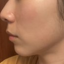 5월 피부근황_주사피부염의 결혼식, 신혼여행 피부상태
