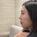 빛으로병원 | [제이필의원 시술후기] 황금빛 원장님 이마+무턱+관자놀이+입술 필러 내돈내산