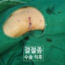 분당서울정형외과 네이버블로그