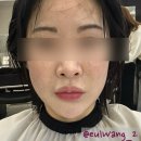 댕이의하루 | 30만원으로 받은 올인원레이저 피지선제거, 화이트닝, 리프팅까지 해주는게 댕이득!
