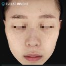 루비마로 | 아꼴레이드 루비레이저 기미 주근깨 치료 내돈내산 총정리