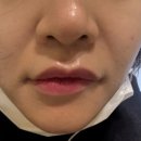바우스 | 바우스 의원 쥬브젠시술 후기-내돈 내산!