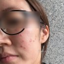 영통한의원 | 수원 영통역 근처 한의원 여드름패인흉터 제거 새살침 후기