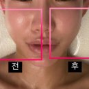 더블유메디케어 | 세종에스테틱 효과적인 하이온리프팅관리 '더블유에스테틱' 강추해요