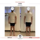 수지척추체형교정