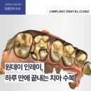 ONE치과기공소 | 원데이 인레이, 하루 만에 끝내는 정밀한 치아 수복