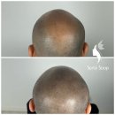 새로이숲부평 | 부평 두피문신 이벤트 하는 곳 찾고 있다면? SMP 탈모 커버 효과까지!