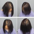 모아로한의원 | 정수리 가르마 탈모 대전smp두피문신 미인모아