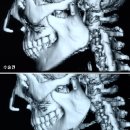 <사각턱수술>사각턱수술전문 강남성형외과의 유익한 사각턱수술 정보!! 이미지