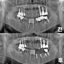 둔산세이정치과의원 | 둔산치과 하악 잇몸 염증으로 인한 통증, 발치 후 임플란트로 해결한 사례