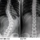 엑스레이 앞에서 허리 옆으로 굽히면 이렇게 안나오겠지? 이미지